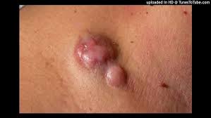 Image result for Dermatofibrosarcoma Protuberans