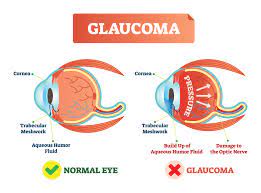 This damage is often caused by an abnormally high pressure in your eye. Glaucoma Overview Signs Testing And Treatment Important Information You Should Know Live Long Lyndhurst Health And Wellness Initiative