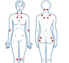 Fibromyalgia is currently understood to be a disorder of central pain processing or a syndrome of central sensitivity. Fibromyalgia Pronacera Therapeutics S L