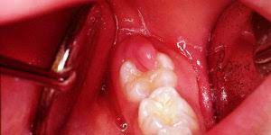 Permanent Tooth Eruption In Children Frisco Kid S Dentistry