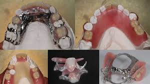 Browse great information and extensive results. All About The Different Types Of Partials Youtube