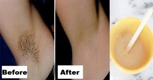 Several kitchen ingredients can be used to treat an underarm rash. You Only Need 2 Ingredients And 2 Minutes To Get Rid Of Underarm Hair Forever