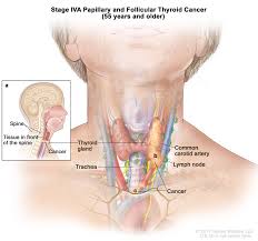 Symptoms predominantly include a sore that does not heal or a change in the voice. Endocrine Surgery Thyroid Cancer