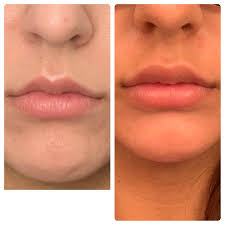 Looking for a medical spa in nyc or miami, fl? About A Month After 1 Syringe Juvederm Ultra Xc Plasticsurgery