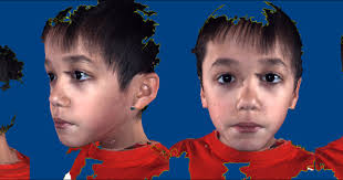 Autistic Children Have Distinct Facial Features Study Suggests