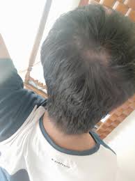 In simple terms, hair thinning at top of the head means light bald spots on top of the scalp. Double Crown Or Thinning 17 Y O Male If It Helps I Ve Always Had A Double Crown Never Paid Much Attention To It But Now I Suddenly Noticed It In A Picture And