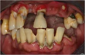 Image result for gums cancer symptoms
