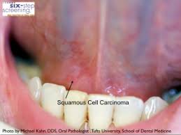 Compared to other cancers, oral cancer is less common—according to the american cancer society , about 54,000 will be diagnosed with oral cancer in 2021. Is It Oral Cancer Six Step Screening