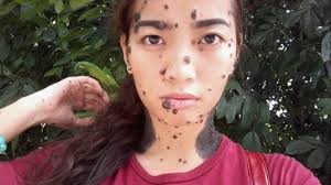 Sel melanosit adalah sel yang berfungsi untuk menghasilkan zat warna kulit yang disebut dengan pigmen. Dulunya Dibully Gara Gara Punya Tahi Lalat Di Sekujur Tubuh Hidup Gadis Ini Sekarang Bikin Kaget Tribun Jatim