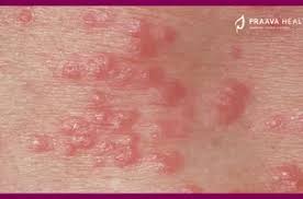Image result for scabies in the groin area