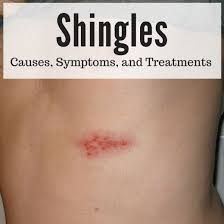 What Causes Shingles What Are The Symptoms And How Is It Treated Shingles Treatment What Causes Shingles Treating Shingles