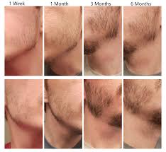 Before and after photos from real minoxidil products user: 6 Months Progress Minoxbeards