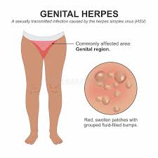 Image result for gonorrhea symptoms