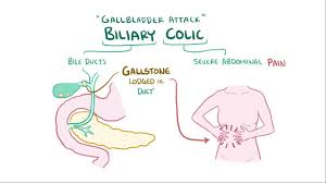 Biliary colic is a steady or intermittent ache in the upper abdomen, usually under the right side of the rib cage. Biliary Colic Osmosis