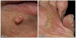Benign melanocytomas may range in size from very small to more than 2.5 inches in diameter. Mimics Of Skin Cancer Ii Skin Cancer 909
