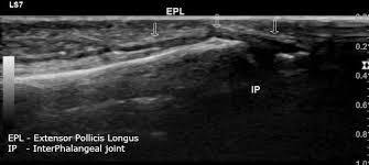 Check spelling or type a new query. Extensor Pollicis Longus Tendon Tear Radiology Case Radiopaedia Org