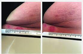 You get the herpes simplex 1 virus by coming into contact with another person who has the virus. A And B Recurrent Hsv 1 Infection In The Right Inferior Medial Buttock Download Scientific Diagram