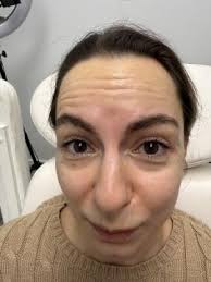 Botox behandeling in Rotterdam