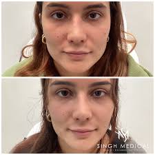 Rejuvenation Before and After