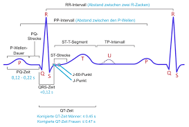 Qt Zeit Verlangerung Long Qt Syndrom Lqts Und Torsades De Pointes Tachykardie Ekg Echo