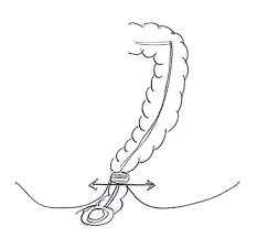 La baisse de la mortalité par cancer colorectal résulte des progrès réalisés dans la détection de la maladie grâce à un diagnostic plus précoce, à une coloscopie de dépistage est proposée tous les 2 ans après 15 à 20 ans d'évolution de la maladie. Colon Apres La Chirurgie Centre Lyonnais De Chirurgie Digestive