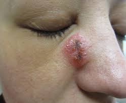 Image result for herpes zoster