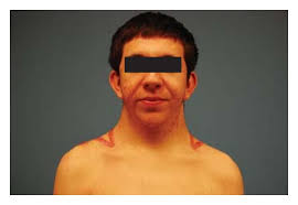 Image result for Webbed Neck