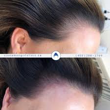 Pin On Hairline Tattooing Hair Tattoo Micropigmentation
