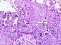 Esophagitis due to herpes simplex virus (hsv) infection1,2. Pathology Outlines Herpes Simplex Zoster