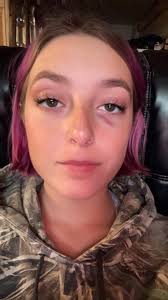 our 7 month old pup gave my girlfriend a black eye, oops 😅