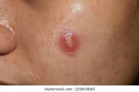 Image result for Pustule