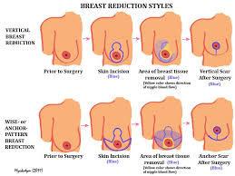 I keep seeing the average cost without insurance, and i can't find any information on how much (on average) it costs if your insurance covers it. Breast Reduction In St Louis Missouri West County Plastic Surgeons