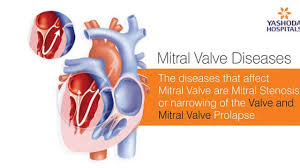 Mitral stenosis (ms) is the narrowing of the mitral valve (mv) orifice, leading to obstructed blood flow from the left atrium (la) to the left ventricle (lv). Transcatheter Mitral Valve Replacement Tmvr For Mitral Valve Diseases