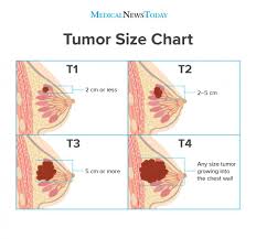 tumor size chart how does tumor size affect breast cancer