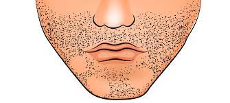 Folliculitis, an infection of one or more hair follicles, causes a tender, red patch of skin and blisters. Why Am I Losing My Beard Hair Fashionbeans