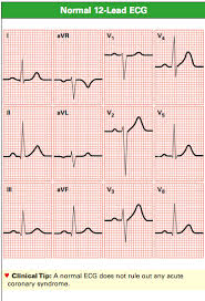 Normal 12 Lead Ecg Complexes Ekg Leads Normal Ecg Cardiology