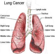 Lung cancer can also produce a high fever and a change in the shape of your fingernails. Description Of Chest Pain In Lung Cancer