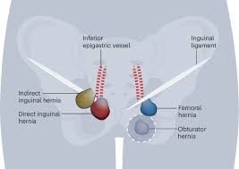 Image result for Hernia Reduction