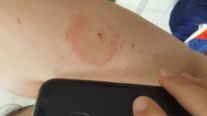 Weiss Jemand Was Das Sein Konnte Roter Kreis Um Muckenstich Gesundheit Und Medizin Mueckenstich