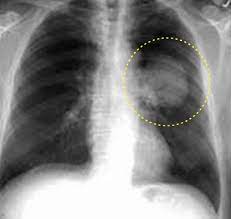Zbytek z periprostatických a periuteriních plexů, kotníkové žíly, aurikula ps (fis), podkličkové a jugulární žíly (kanylace). Plicni Tumor Rtg Medicina Nemoci Studium Na 1 Lf Uk