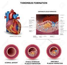 Blood Clot Formation Coronary Artery Disease Anatomy Of Healthy Royalty Free Cliparts Vectors And Stock Illustration Image 38473543