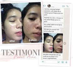 Dibawah ini adalah sebuah reaksi yang sangat umum terjadi apabila awal pemakaian cream ms glow. Mengenal Harga Red Jelly Ms Glow Dan Efek Sampingnya Tagar Berita