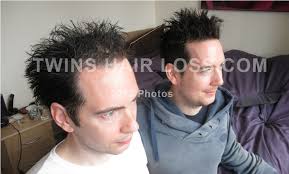 .5mg pills of avodart (dutasteride) is what it comes in, and yes it is bad to remove that much dht from your body, and it wont make a difference on hair that you will see. Hairloss Photo 4 Comparison In 2013 Twins Hair Loss