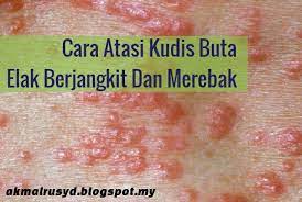 Tidak hanya pada bayi, kudis juga dapat menyerang orang dewasa yang bisa muncul pada pada bagian tubuh man saja, bahkan bisa muncul di area pangkal paha sampai organ intim wanita maupun pria. Cara Mengatasi Kudis Buta Dengan Berkesan Elak Merebak Dan Berjangkit