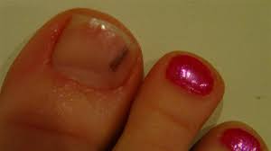 Subungual melanomas usually appear as a brown or black toenail fungus infections are the result of various fungal organisms. Will Our Adventure Be Cancelled Because Of A Big Toe Family Adventuring