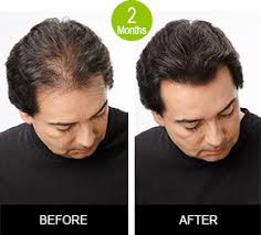 Hair oil and hair serum can sometimes seem interchangeable, but they're actually very different. Hair Fall And Regrowth 100 Proven Product Kit Only Result Oriented Product