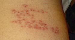 Image result for shingles in children