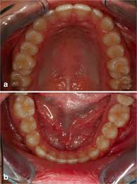 Image result for Occlusal