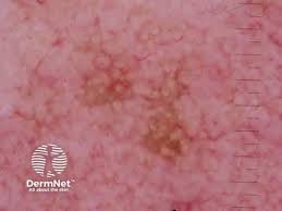 Annular granular pattern seen in pigmented actinic keratosis image