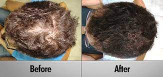 Ideal for thinning hair treatment women and men. Professional Laser Hair Therapy Clinically Proven 90 Effective
